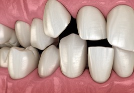 Illustration of spaced-out teeth