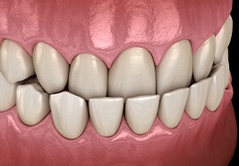 Illustration of an underbite