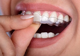 Closeup of someone inserting clear aligners over their top teeth